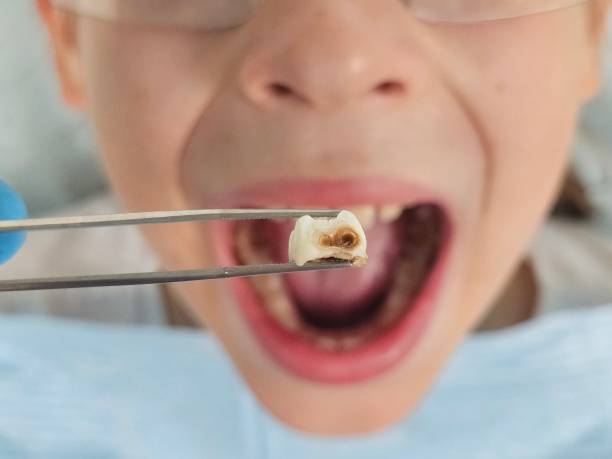 Best Root Canal Emergency Dentist  in Colbert, OK